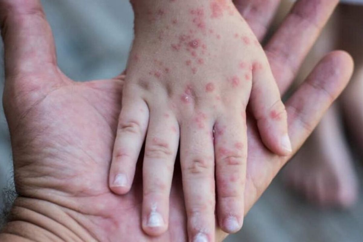 cacar monyet di riau, kasus monkeypox Indonesia 2025, santri meninggal cacar monyet, gejala cacar monyet pada manusia, cacar monyet Kepulauan Meranti, dugaan monkeypox di pesantren, kematian akibat cacar monyet Riau, update kasus cacar monyet hari ini, 1 Orang di Riau Meninggal Diduga Cacar Monyet, 3 Lainnya Suspek, Satu meninggal, tiga lainnya suspek, Gejala mirip monkeypox, masil lab masih ditunggu, Bupati Meranti instruksikan penanganan cepat, Pemda imbau warga waspada, tidak panik
