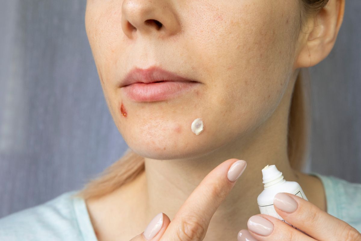 Manfaat salicylic acid, obat jerawat alami, manfaat salicylic acid, salicylic acid untuk jerawat, cara pakai salicylic acid, bahan aktif untuk jerawat, Salicylic Acid untuk Jerawat: Manfaat, dan Tips Penggunaannya, 1. Membersihkan pori-pori, 2. Mengurangi produksi minyak, 3. Eksfoliasi kulit, 4. Mencegah peradangan