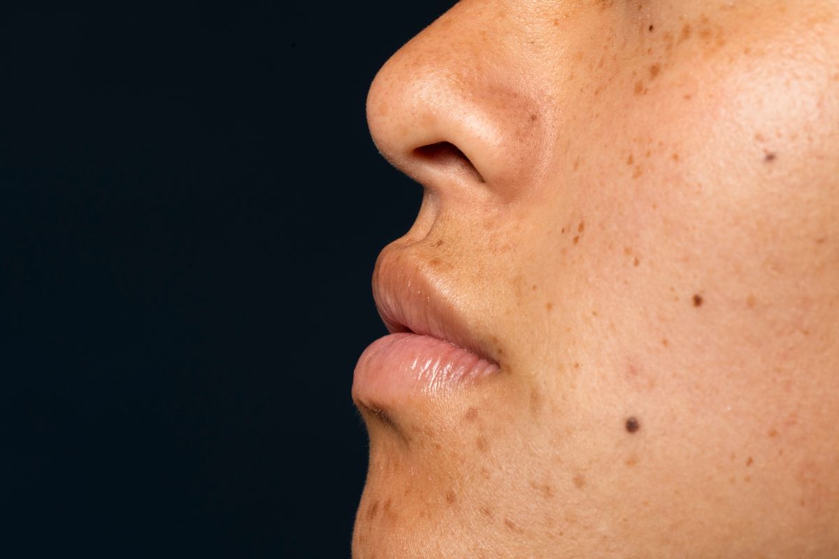 hiperpigmentasi, flek hitam di wajah, cara mengatasi flek hitam, dark spots, cara mengatasi flek hitam di wajah, skincare untuk flek hitam, penyebab flek hitam di wajah, dokter spesialis kulit kelamin dan estetika, flek hitam di wajah dan cara mengatasinya, tips skincare kulit flek hitam, Cara Mengatasi Flek Hitam di Wajah Menurut Dokter, Ini 4 Langkah Skincare Wajib, 1. Pembersihan dengan triple cleansing , 2. Nutrisi kulit, 3. Perlindungan, 4. Regenerasi