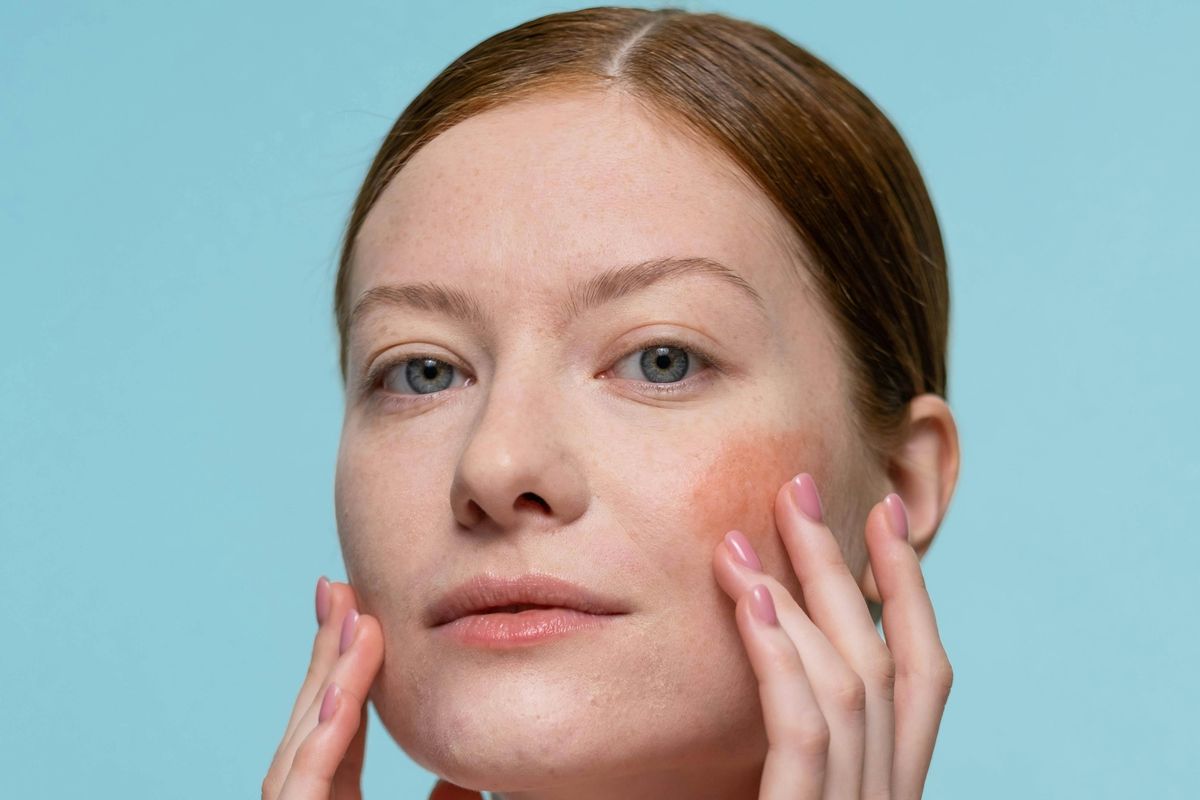 Rosacea, rosacea, rosacea adalah, rosacea itu apa, rosacea bisa sebabkan depresi, rosacea ganggu kesehatan mental, Tak Hanya Bikin Muka Merah, Rosacea Bisa Ganggu percaya Diri hingga Depresi, Memengaruhi kualitas hidup dan aktivitas harian, Menurunkan rasa percaya diri, Menyebabkan depresi, Cara mengatasi rosacea