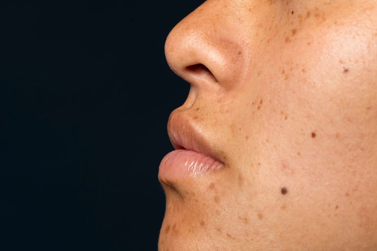 Flek hitam, flek di wajah, flek hitam di wajah, arbutin, arbutin adalah, arbutin untuk apa, manfaat arbutin untuk flek hitam, menghilangkan flek hitam di wajah, Benarkah Arbutin Bisa Hilangkan Flek Hitam di Wajah? Ini Kata Ahli, Benarkah arbutin menghilangkan flek hitam di wajah?, Jenis abutin yang lebih efektif, Arbutin vs bahan pencerah kulit lainnya, Manfaat arbutin untuk kulit, Cara menggunakan arbutin dengan aman
