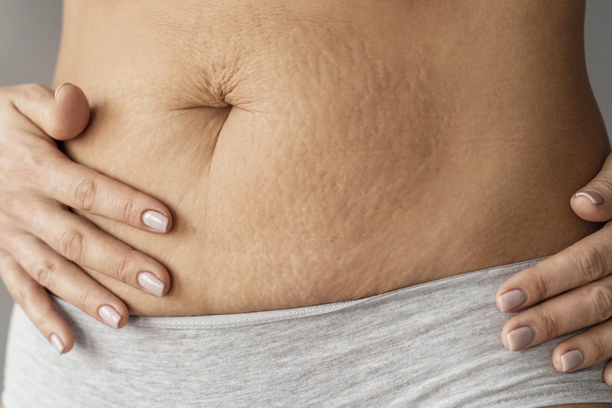 stretch mark, 7 Cara Mencegah Stretch Mark agar Tak Makin Parah, 1. Menjaga tubuh tetap terhidrasi agar kulit lebih elastis, 2. Menggunakan produk dengan kandungan centella asiatica, 3. Memakai skincare hyaluronic acid, 4. Menjaga berat badan tetap stabil, 5. Rutin berolahraga , 6. Menggunakan retinoid setelah kehamilan, 7. Mencoba microneedling 