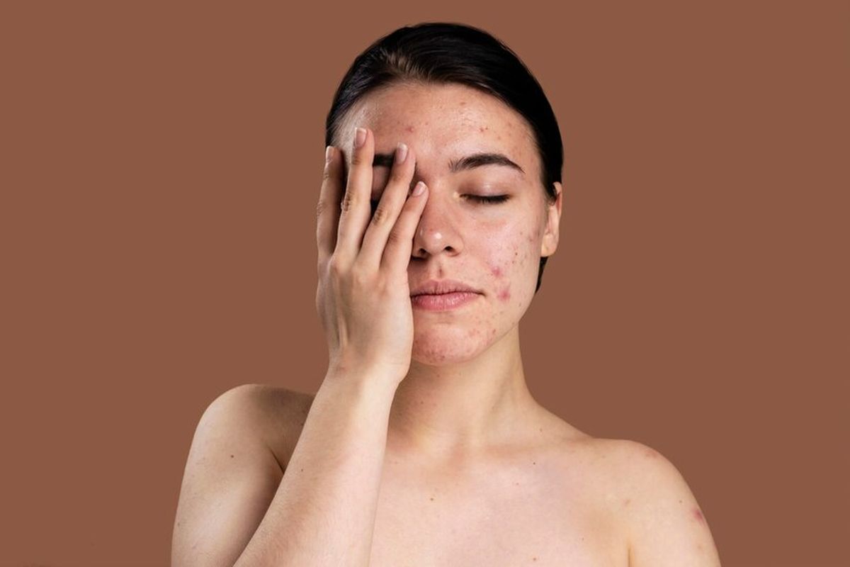 jerawat, klinik kecantikan, Jerawat, perawatan kulit, Klinik kecantikan, Kapan Sebaiknya Jerawat Diobati di Klinik Kecantikan, tanda jerawat tidak bisa diatasi dengan skincare, tanda jerawat harus diobati di klinik kecantikan, apa jadinya jika jerawat dibiarkan, kapan harus ke dokter untuk mengobati jerawat, jerawat tak kunjung sembuh, tanda peradangan pada jerawat, Jerawat Tak Kunjung Sembuh, Kapan Harus ke Dokter?