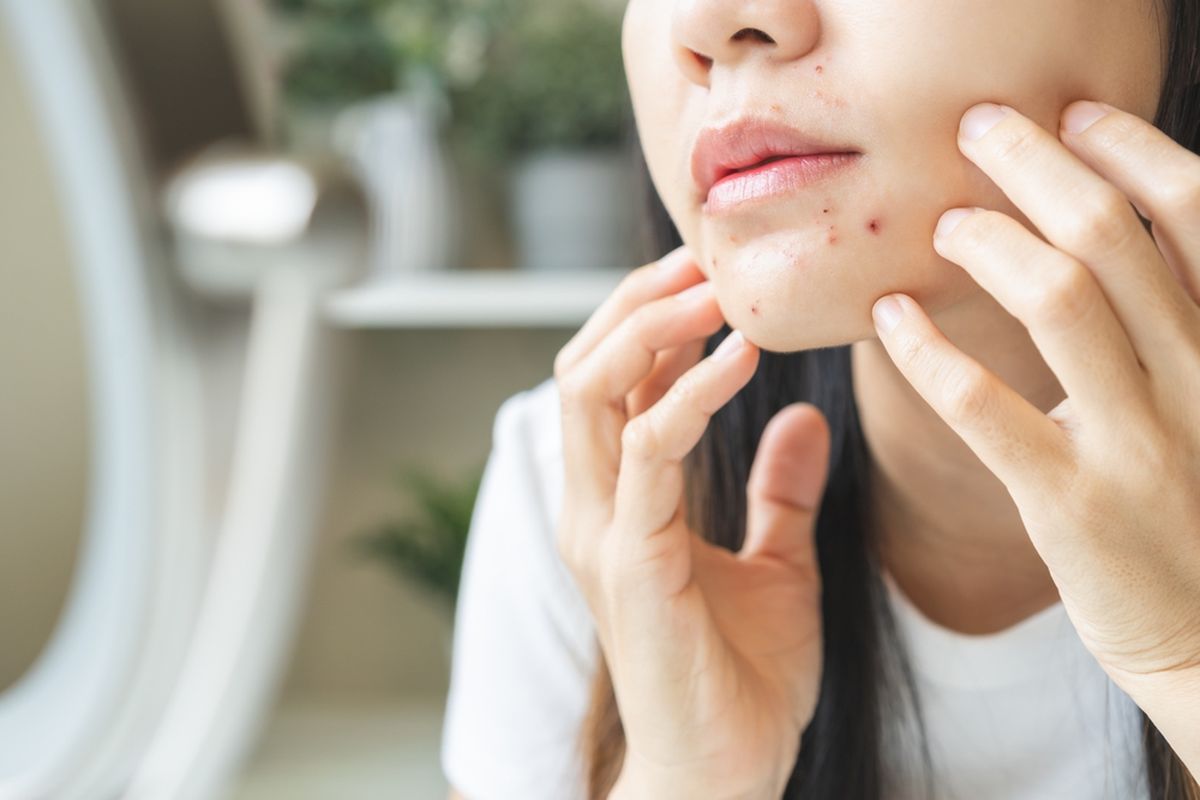 jerawat di bibir, Penyebab jerawat di bibir, obat jerawat, penyebab jerawat di bibir, jerawat di bibir artinya, kenapa jerawat muncul di bibir, Faktor Penyebab dan Cara Mengobati Jerawat di Bibir