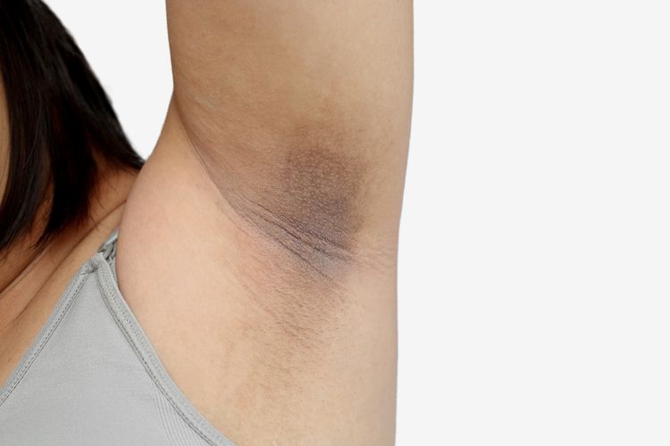 mencukur bulu ketiak, cara menghilangkan bulu ketiak, cara mencukur bulu ketiak, shaving, cukur bulu ketiak, apakah shaving bikin ketiak hitam, Kenapa mencukur ketiak bikin hitam, Apakah Shaving Bikin Ketiak Hitam? Simak Jawaban Dokter
