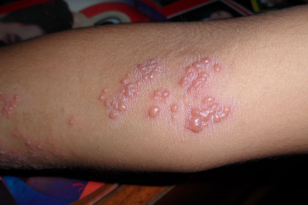 Cacar api, herpes zoster, kelompok lansia, cacar api, vaksinasi cacar api, Cacar Api, kapan harus vaksin cacar api, syarat vaksin cacar api, Kapan Harus Vaksin Cacar Api? Ini 4 Kondisi yang Harus Diperhatikan, 1. Berusia 50 tahun ke atas, 2. Memiliki kondisi khusus seperti kanker atau autoimun, 3. Tidak sedang mengalami infeksi, 4. Tidak dianjurkan saat sedang sakit