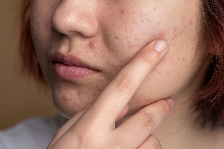 Flek hitam, hiperpigmentasi, mengatasi flek hitam, dark spots, kojic acid, bahan untuk mengatasi flek hitam, apakah kojic acid bisa menghilangkan flek hitam, Apakah Kojic Acid Efektif Memudarkan Flek Hitam?
