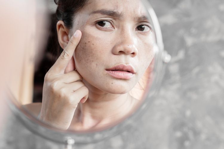 treatment, Flek hitam, hiperpigmentasi, mengatasi flek hitam, flek hitam di wajah, flek hitam, mengatasi flek hitam di wajah, treatment untuk flek, treatment flek hitam, Daftar Treatment untuk Menghilangkan Flek Hitam di Wajah, Sudah Coba?, 1. Laser treatment , 2. Chemical peeling, 3. Cryosurgery, 4. Microdermabrasion