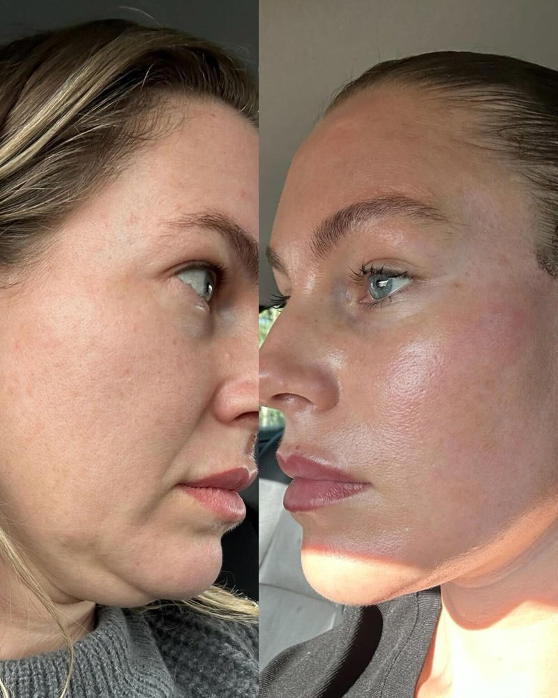 The decision to undergo a facelift., The procedure., The recovery., The commentary around her decision.