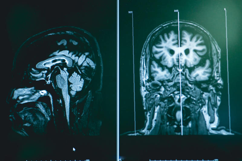 What causes young onset dementia? What is younger onset dementia?, Consequences of dementia, Recognizing the condition, Signs and symptoms, Advanced signs and symptoms, What causes young onset dementia?, Early diagnosis, Planning for the future, Work out a support plan, Financial affairs, Reduce stress levels, Exercise the brain, Eat properly