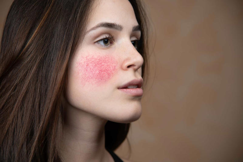 Red face Loss of smell, Abdominal bloating, Unexpected weight loss, Neck stiffness, Change of humor, Knee pain, Coughing, Red face, Stomach ache, Calf pain, Blood in urine, Erectile dysfunction, Itchy skin, Forgetfulness