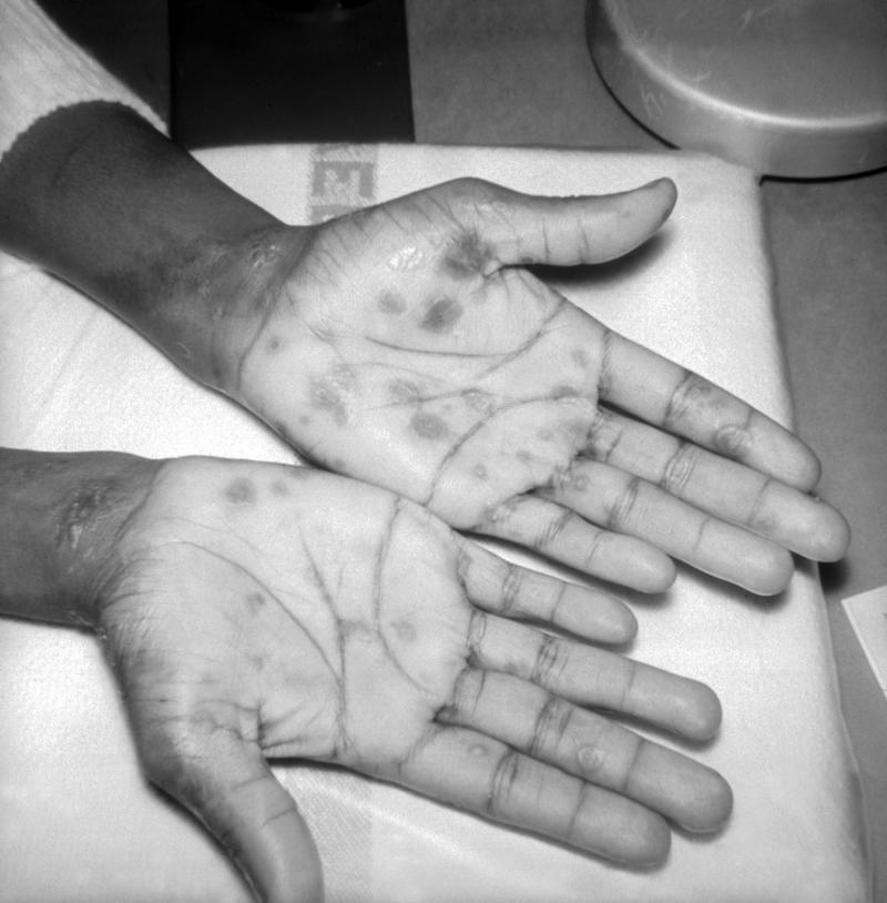 Why is syphilis so dangerous? America's dark history of medical racism, Unethical human experimentation, James Marion Sims, Eugenics and nonconsensual sterilization, The 1946 STD Inoculation Study, Yellow fever in Georgia, The Tuskegee Syphilis Study, Why is syphilis so dangerous?, Oslo, 1928, Macon County, Alabama, The 'volunteers', The lies, The 'treatments', Blocking treatment access, Forty years of suffering, World War II