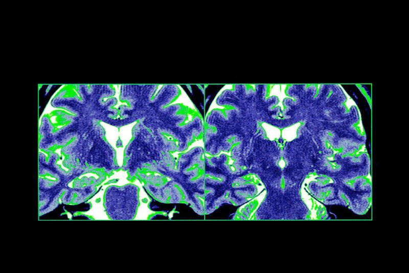 Rough childhood, Root cause, Does trauma change the brain?, Trauma combo, What is the hippocampus?, Consequences of damage, Impact of aging, Linked to disorders, What are the triggers?, Hypothesis, Methodology, Evaluation, Questionnaires, Impact analysis, Types of maltreatment, Love treatment