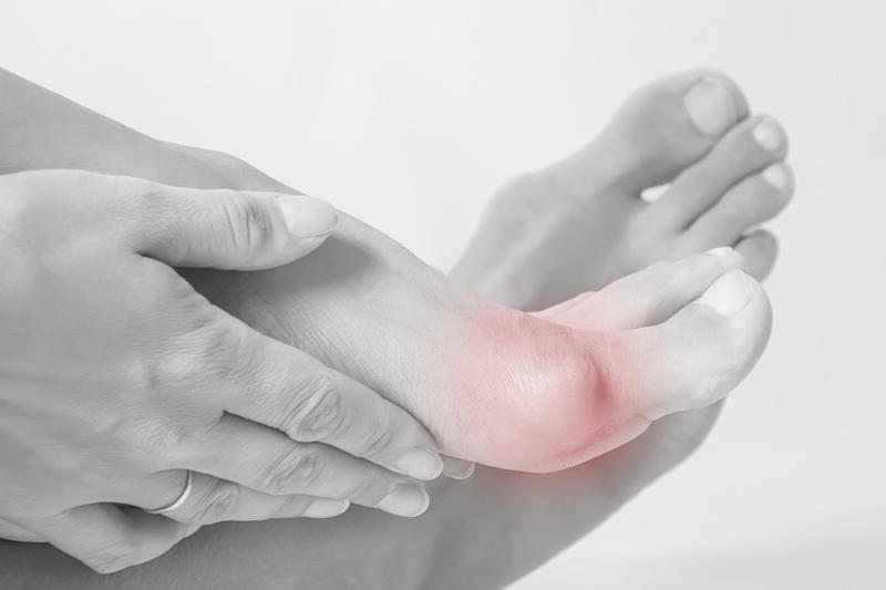 Nerves and crowding What's a bunion?, Slow development, Who is affected?, An acquired deformity, Foot shape, Egyptian foot shape, Early signs, Bunion pain, Nerves and crowding, Treatment options, At-home relief, Pharmacy products