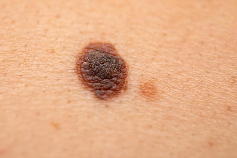 Melanoma Vitamin D, Calcium and phosphate levels, Mood boost, Sleep-wake cycle, Reduced risk of seasonal affective disorder, "Winter blues", SAD treatment, Dangers of long-term exposure to sunlight, Melanoma, Skin aging, Cataracts, Snow blindness, Heart disease, Least sunniest place on Earth