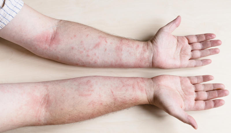 Contact dermatitis The Human Cell Atlas project, Seborrheic keratosis, Age spots, Cherry angioma, Solar elastosis, Spider veins, Contact dermatitis, Contact dermatitis and aging, Sagging skin, Skin cancer, Celebrities who embrace their aging skin: Meryl Streep, Susan Sarandon, Avoid tanning, Avoid smoking, Changing position often, Manage stress