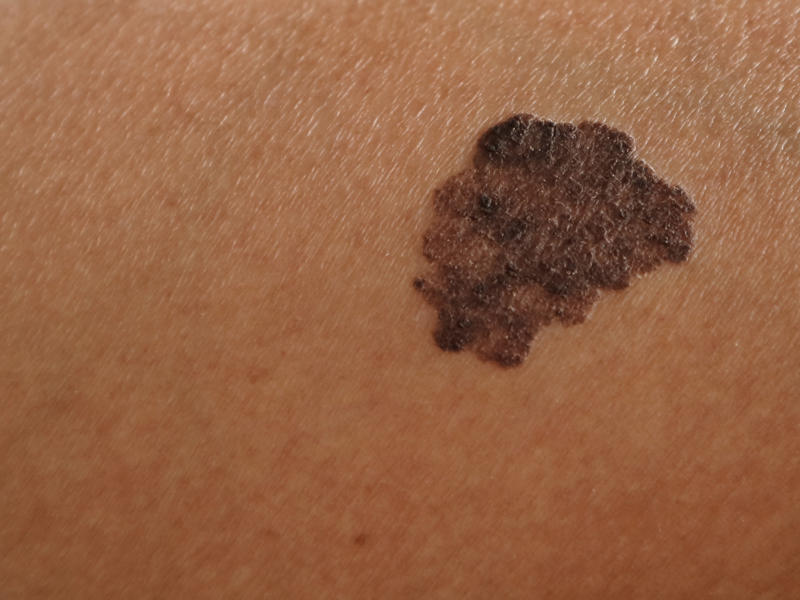Skin cancer The Human Cell Atlas project, Seborrheic keratosis, Age spots, Cherry angioma, Solar elastosis, Spider veins, Contact dermatitis, Contact dermatitis and aging, Sagging skin, Skin cancer, Celebrities who embrace their aging skin: Meryl Streep, Susan Sarandon, Avoid tanning, Avoid smoking, Changing position often, Manage stress