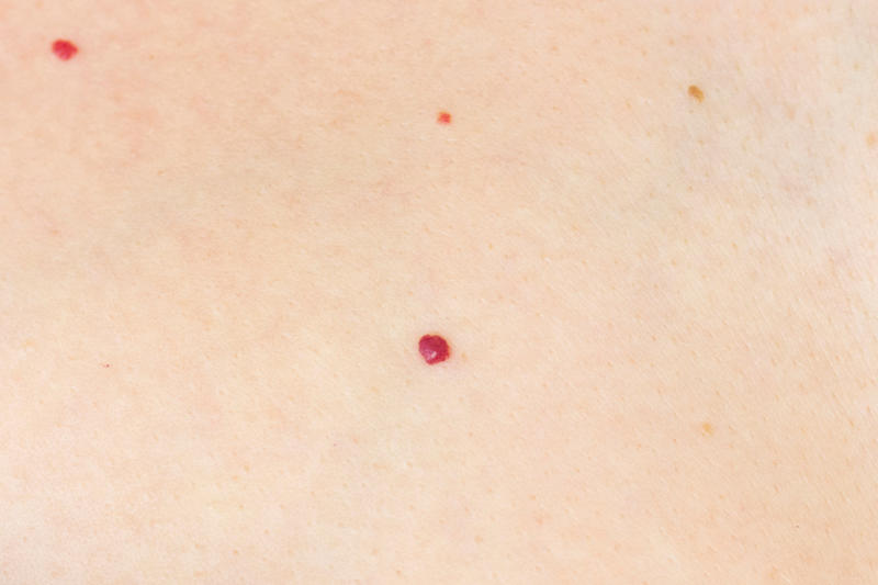 Cherry angioma The Human Cell Atlas project, Seborrheic keratosis, Age spots, Cherry angioma, Solar elastosis, Spider veins, Contact dermatitis, Contact dermatitis and aging, Sagging skin, Skin cancer, Celebrities who embrace their aging skin: Meryl Streep, Susan Sarandon, Avoid tanning, Avoid smoking, Changing position often, Manage stress