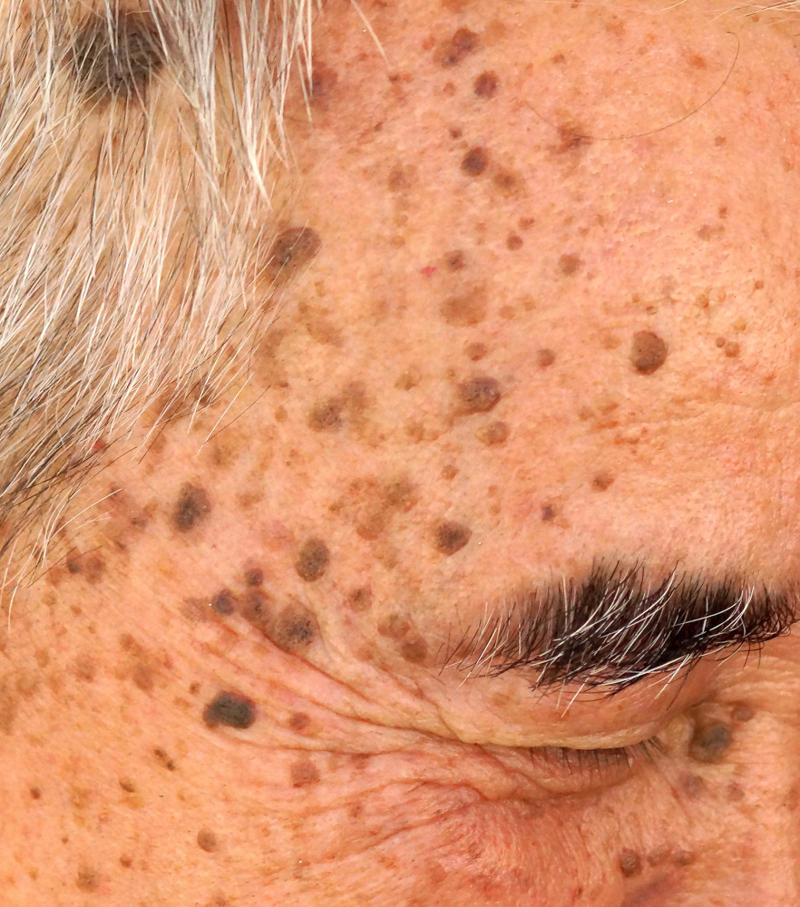 Seborrheic keratosis The Human Cell Atlas project, Seborrheic keratosis, Age spots, Cherry angioma, Solar elastosis, Spider veins, Contact dermatitis, Contact dermatitis and aging, Sagging skin, Skin cancer, Celebrities who embrace their aging skin: Meryl Streep, Susan Sarandon, Avoid tanning, Avoid smoking, Changing position often, Manage stress