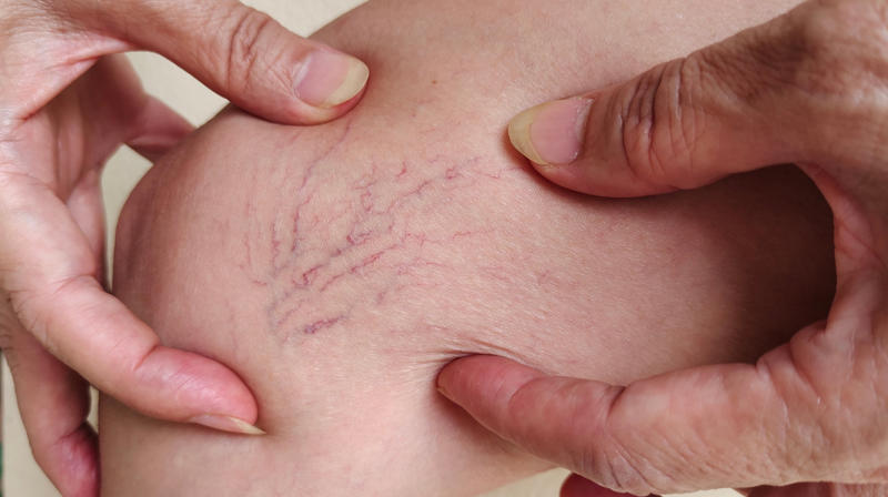 Spider veins The Human Cell Atlas project, Seborrheic keratosis, Age spots, Cherry angioma, Solar elastosis, Spider veins, Contact dermatitis, Contact dermatitis and aging, Sagging skin, Skin cancer, Celebrities who embrace their aging skin: Meryl Streep, Susan Sarandon, Avoid tanning, Avoid smoking, Changing position often, Manage stress