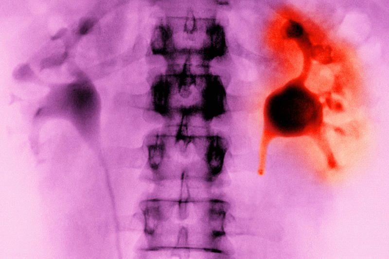 Toothache, Renal colic, Heart attack, Endometriosis, Peripheral neuropathy, Fibromyalgia, Trigeminal neuralgia, Interstitial cystitis, Intracranial hypertension, Dercum's disease, Complex regional pain syndrome, Peritonitis, Frozen shoulder, Stomach ulcer, Emotional pain