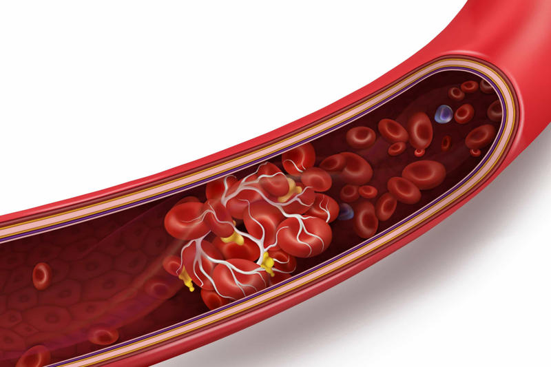 When are they dangerous? What are blood clots?, When are they dangerous?, How common is it?, Where do they usually develop?, Common symptoms of a DVT, Blood clots can cause strokes, How to treat a blood clot, Move every two to three hours, Wear loose-fitting pants, socks, or stockings, Get on the floor, Eat less salt, Avoid too much alcohol, Limit animal fats, Avoid unhealthy trans fats, Don’t self-diagnose