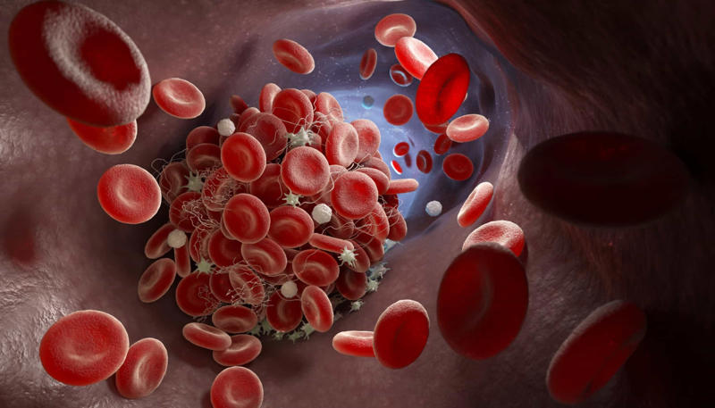 What are blood clots? What are blood clots?, When are they dangerous?, How common is it?, Where do they usually develop?, Common symptoms of a DVT, Blood clots can cause strokes, How to treat a blood clot, Move every two to three hours, Wear loose-fitting pants, socks, or stockings, Get on the floor, Eat less salt, Avoid too much alcohol, Limit animal fats, Avoid unhealthy trans fats, Don’t self-diagnose