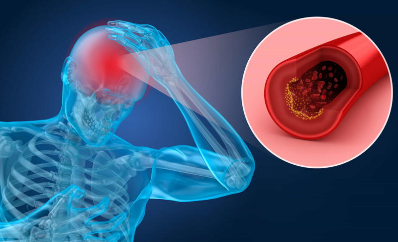 Blood clots can cause strokes What are blood clots?, When are they dangerous?, How common is it?, Where do they usually develop?, Common symptoms of a DVT, Blood clots can cause strokes, How to treat a blood clot, Move every two to three hours, Wear loose-fitting pants, socks, or stockings, Get on the floor, Eat less salt, Avoid too much alcohol, Limit animal fats, Avoid unhealthy trans fats, Don’t self-diagnose