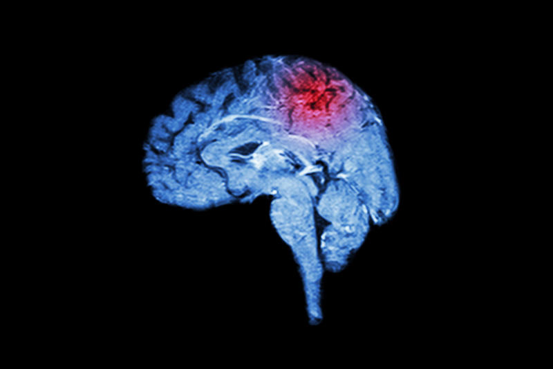 The elusive nature of brain fog, Beyond COVID, Chronic illness and cognitive challenges, Shared symptoms, Functional deficits, Dismissal of symptoms, Autoantibodies, Leaky blood-brain barrier, The hormonal connection, Traumatic brain injuries, Microbial imbalance, Seeking medical assessment, Repurposing drugs, Immunotherapy