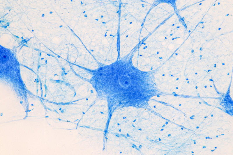 Central nervous system MSF statement, Travel warnings, Worldwide issue, Cheap method, Home brewing, Methanol, Not safe for human consumption, Formaldehyde, Central nervous system, Severe consequences, Fomepizole, Dialysis