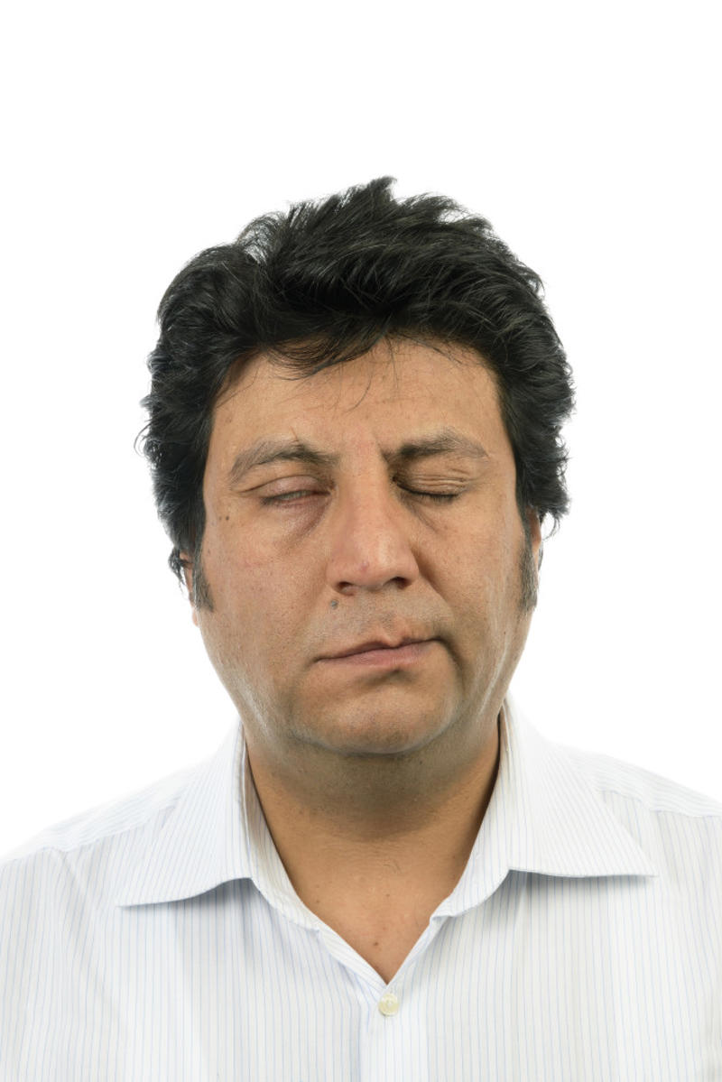 Dangerous disease, What is a stroke?, Quick response, Diagnosis, Emergency, Other signs, Body numbness, Dizziness, Types of strokes, Ischemic stroke, Ischemic stroke subtype, Hemorrhagic stroke causes, Hemorrhagic stroke risk factor, Most affected groups, Medical exam, Further exams, Echocardiogram, Ischemic stroke treatment, Hemorrhagic stroke treatment, Paralysis or loss of movement, Deep vein thrombosis (DVT)
