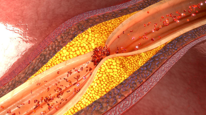 Dangerous disease, What is a stroke?, Quick response, Diagnosis, Emergency, Other signs, Body numbness, Dizziness, Types of strokes, Ischemic stroke, Ischemic stroke subtype, Hemorrhagic stroke causes, Hemorrhagic stroke risk factor, Most affected groups, Medical exam, Further exams, Echocardiogram, Ischemic stroke treatment, Hemorrhagic stroke treatment, Paralysis or loss of movement, Deep vein thrombosis (DVT)