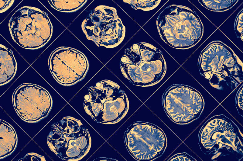 Dangerous disease, What is a stroke?, Quick response, Diagnosis, Emergency, Other signs, Body numbness, Dizziness, Types of strokes, Ischemic stroke, Ischemic stroke subtype, Hemorrhagic stroke causes, Hemorrhagic stroke risk factor, Most affected groups, Medical exam, Further exams, Echocardiogram, Ischemic stroke treatment, Hemorrhagic stroke treatment, Paralysis or loss of movement, Deep vein thrombosis (DVT)