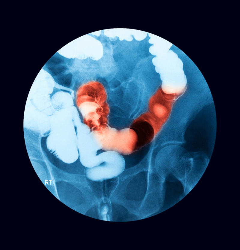 Risk factors Millennial diagnosis, Colorectal cancer, Abdominal pain, Stool changes, Loss of appetite, Risk factors, Heavy alcohol consumption, Ulcerative colitis and Chron's disease, Gut microbiome, Screening