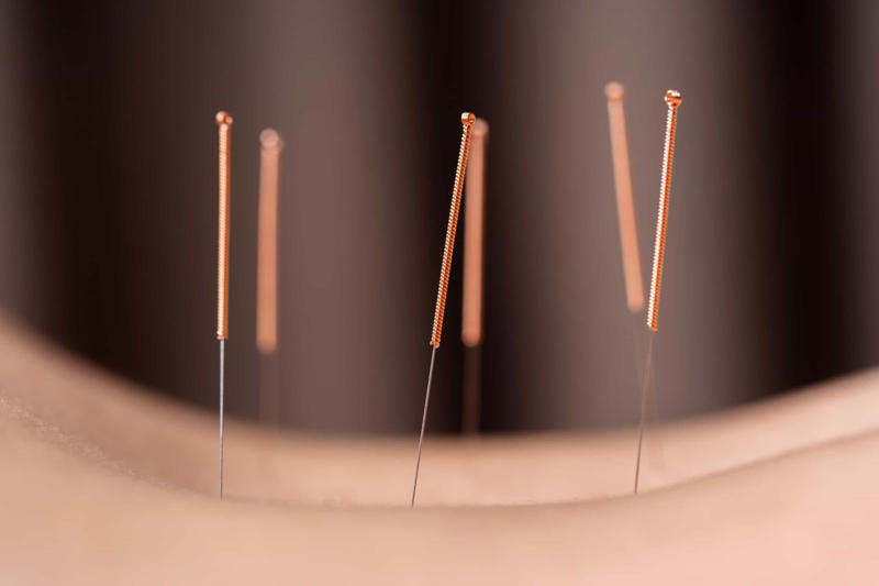 Acupuncture is preventative medicine The origin of the word, Qi plays a vital role in acupuncture, There are over 300 acupuncture points on the body, Acupuncture has very few side effects, Almost anyone can benefit from acupuncture, Even animals can get acupuncture, It takes a lot of training to become a licensed acupuncturist, Acupuncturists look at your tongue and feel your pulse, Acupuncture is preventative medicine, Today's acupuncture needles, Acupuncture is often covered by health insurance, When in doubt, ask