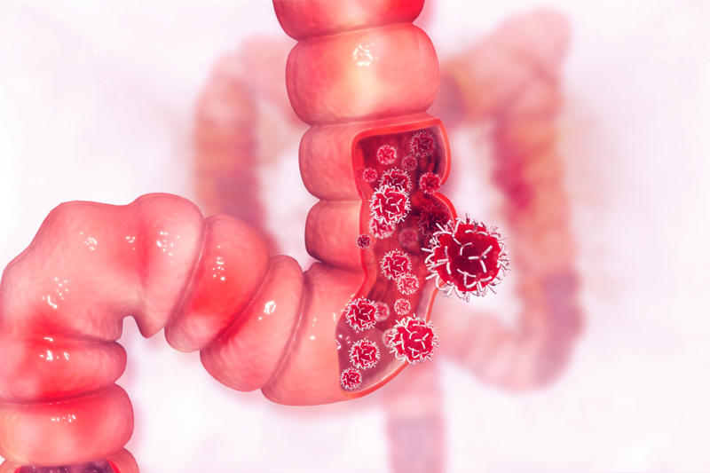 Colorectal cancer Millennial diagnosis, Colorectal cancer, Abdominal pain, Stool changes, Loss of appetite, Risk factors, Heavy alcohol consumption, Ulcerative colitis and Chron's disease, Gut microbiome, Screening