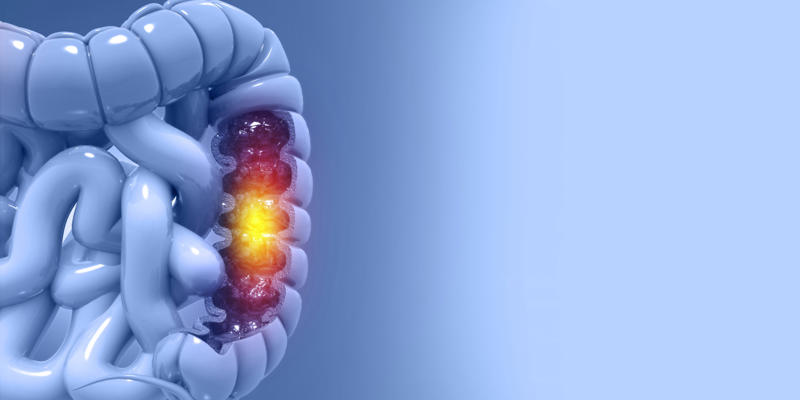 Colorectal cancer Millennial diagnosis, Colorectal cancer, Abdominal pain, Stool changes, Loss of appetite, Risk factors, Heavy alcohol consumption, Ulcerative colitis and Chron's disease, Gut microbiome, Screening