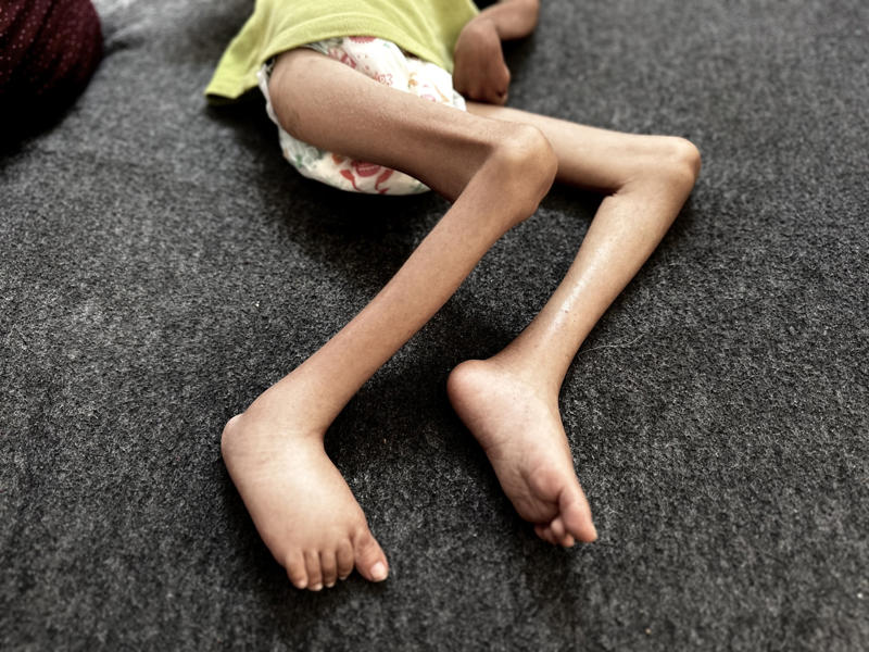 Oral medication Type 5 diabetes, Africa and Asia, Organ underdevelopment, Misclassified, Distinction between variants, Oral medication, Ensuring care, Effectively managing the condition, Unusual form of diabetes, Standard therapeutic models were ineffective, Diet-induced diabetes, Unrecognized, Change disease progression
