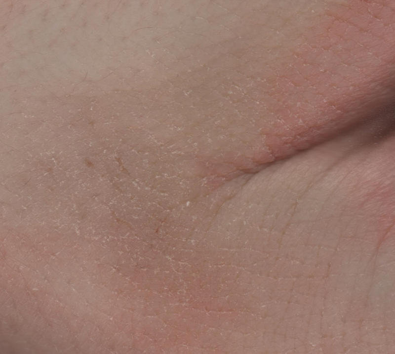 Skin Changes: Redness, Dryness, and Cracking The Immediate Shock: Cold Receptors Activate, Vasoconstriction: Blood Vessels Narrow, Shivering: The Body’s Internal Furnace, Goosebumps and Hair Erection, Slowed Nerve Signals: Numbness and Clumsiness, Reduced Muscle Performance, Frostnip and Frostbite: Tissue Damage Begins, Hypothermia: The Core Temperature Drops, The Paradoxical Undressing Phenomenon, Cold Diuresis: The Urge to Urinate, Heart Strain and Arrhythmias, Respiratory Effects: Cold Air and Your Lungs, Immune System Changes, Dehydration: The Hidden Danger, Metabolic Slowdown: Energy Conservation, Behavioral Changes: Confusion and Apathy, Skin Changes: Redness, Dryness, and Cracking, Eye Irritation and Vision Problems, Sleep Disruption and Fatigue, Burning Calories: Increased Energy Demand, The Limits of Human Survival