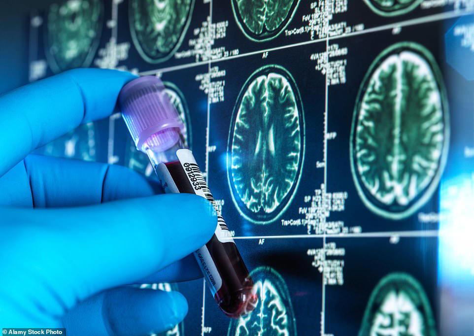 Two key factors of dementia risk that outweigh all others