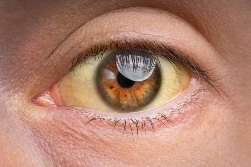 What is hepatitis?, What causes them?, What are some of the biggest misconceptions about hepatitis?, What are some signs of hepatitis?, Can hepatitis lead to serious complications if left untreated?, Can hepatitis be prevented?, Can hepatitis is treated?