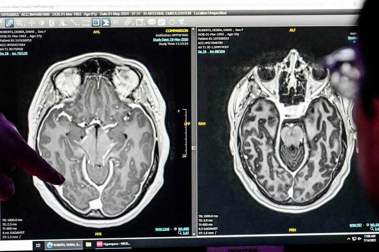 A rare medical condition, Years of frustration, Finding an answer, Pinpointing the problem, A simpler solution, Pioneering a treatment, Related Reading, Subscribe