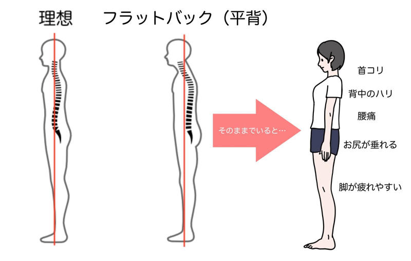 生理的湾曲の大切さ, S字カーブが崩れると不快症状の原因に, フラットバックの原因, 実施時のポイント・注意事項