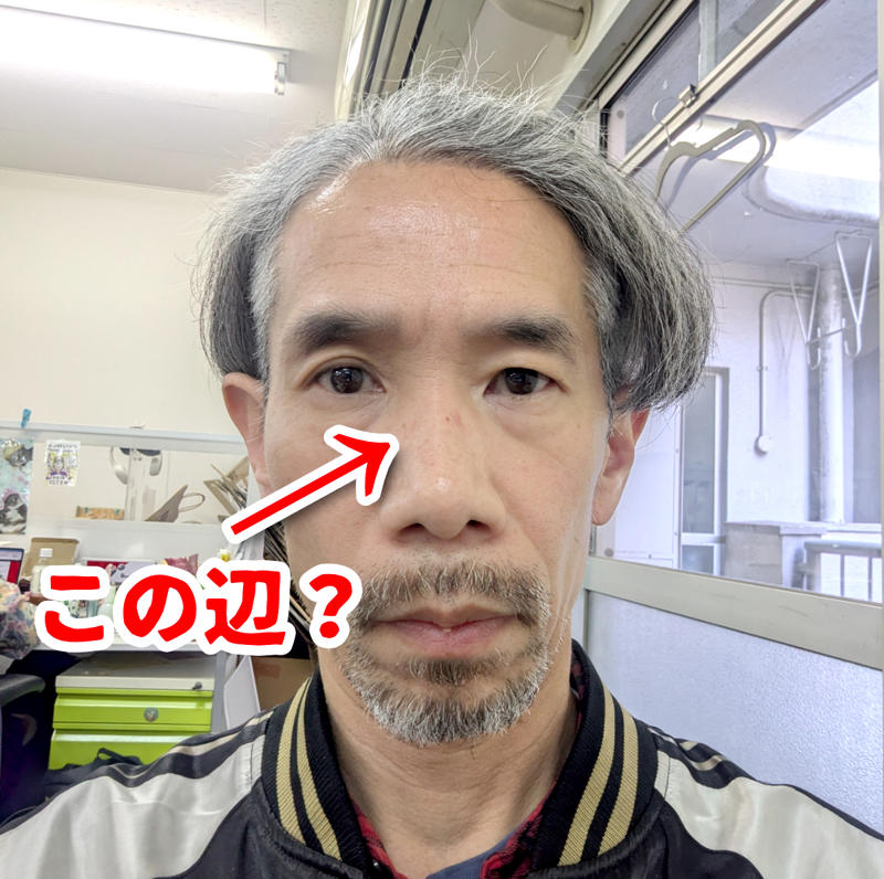 ・ライバルとのケンカ説, ・顔から転んだ説, ・ボールが当たった説, ・猫に引っかかれた説, ・もしかして「サビオか」？