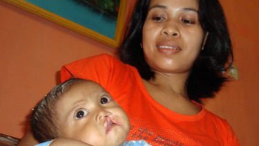 Ribuan Bayi Lahir dengan Bibir Sumbing, Kenali Risiko dan Pentingnya Operasi Dini