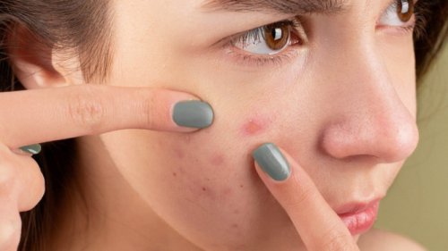 Dokter Ungkap Kasus Jerawat Berujung Meningitis, Peringatkan Jangan Pencet Area Ini