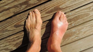 Top 6+ Tanda Penyakit Serius yang Bisa Terlihat dari Kaki, Nomor 3 Paling Sering Terjadi