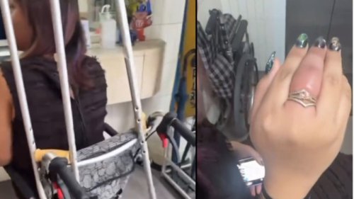Duduk di Kursi Roda dan Jari Bengkak, Begini Kondisi Putri Eko Patrio di Jepang