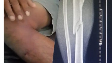 Pengakuan Tahanan Polisi, Dipukul Balok hingga Patah Tulang