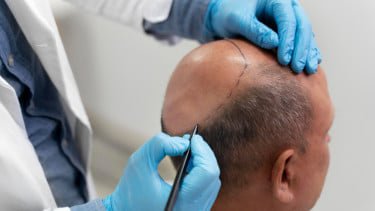 Memahami Perbedaan Transplantasi Rambut DHI Asli dan Palsu, Jangan Ketipu!